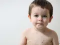 Bambino di 2 anni con puntini rossi intorno alla bocca e sul corpo, forse varicella.