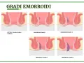Illustrazione dei gradi di emorroidi, da normali a stadio 4. Capire quando preoccuparsi è fondamentale.