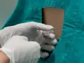 Mani guantate eseguono un'iniezione epidurale, sollevando interrogativi sugli epidurale effetti collaterali a lungo termine.