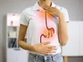 Persona con bruciore di stomaco, immagine di un esofago e stomaco infuocati. Potrebbe essere utile omeprazen 20 mg.