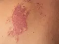 Macchia rossastra sulla pelle, simile a un morso della cicogna adulto, con piccole protuberanze.