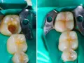 Prima e dopo: un dente con carie profonda e il suo ripristino con otturazione estetica.