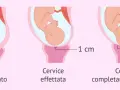 Illustrazione del nono mese di gravidanza: utero con feto, cervice non dilatata, dilatata 1 cm e completamente dilatata (10 cm).