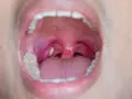Gola infiammata con tonsille rosse e gonfie, dove si notano evidenti calcoli tonsillari giallastri.