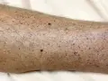 Gambe con numerosi puntini rossi e qualche neo scuro, senza segni di prurito.