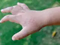 Mano di bambino con puntini rossi sulle dita e sul dorso, senza segni di prurito.