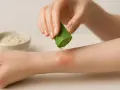 Aloe vera lenisce la pelle secca e prurito. Rimedi naturali per il benessere della pelle.