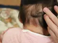 Dita accarezzano la nuca di un neonato, dove si notano delle piccole macchie rosse, un segno del "morso della cicogna".