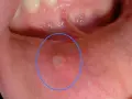 Una piccola afte, simile a bolle sulle labbra, circondata da un alone rosso, visibile all'interno della bocca.