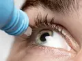 Goccia di collirio antibiotico cade sull'occhio, alleviando un'infezione.