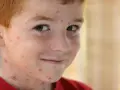 Primo giorno di varicella per questo bimbo con i capelli rossi, il viso e il collo coperti di bolle rosse.