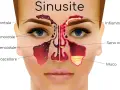 Illustrazione anatomica della sinusite, con seni frontali, etmoidali, sfenoidali e mascellari infiammati e ostruiti da muco. Utile per capire i rimedi.