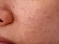 Primo piano della pelle con pori dilatati e alcuni punti neri visibili, che creano una texture irregolare.