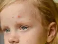 Viso di bambina con eruzioni cutanee, possibili segni di orticaria da streptococco nei bambini.