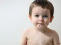 Bambino con puntini rossi sul viso e sul corpo, forse la varicella.