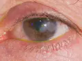 Occhio con segni di herpes, arrossamento e secrezioni giallastre. La cornea presenta un'area opaca e verdeggiante.
