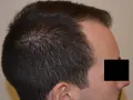Profilo di un uomo con diradamento dei capelli nella zona della corona, indicativo di alopecia androgenetica.