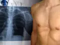 Medico mostra radiografia torace, evidenziando un petto a imbuto.