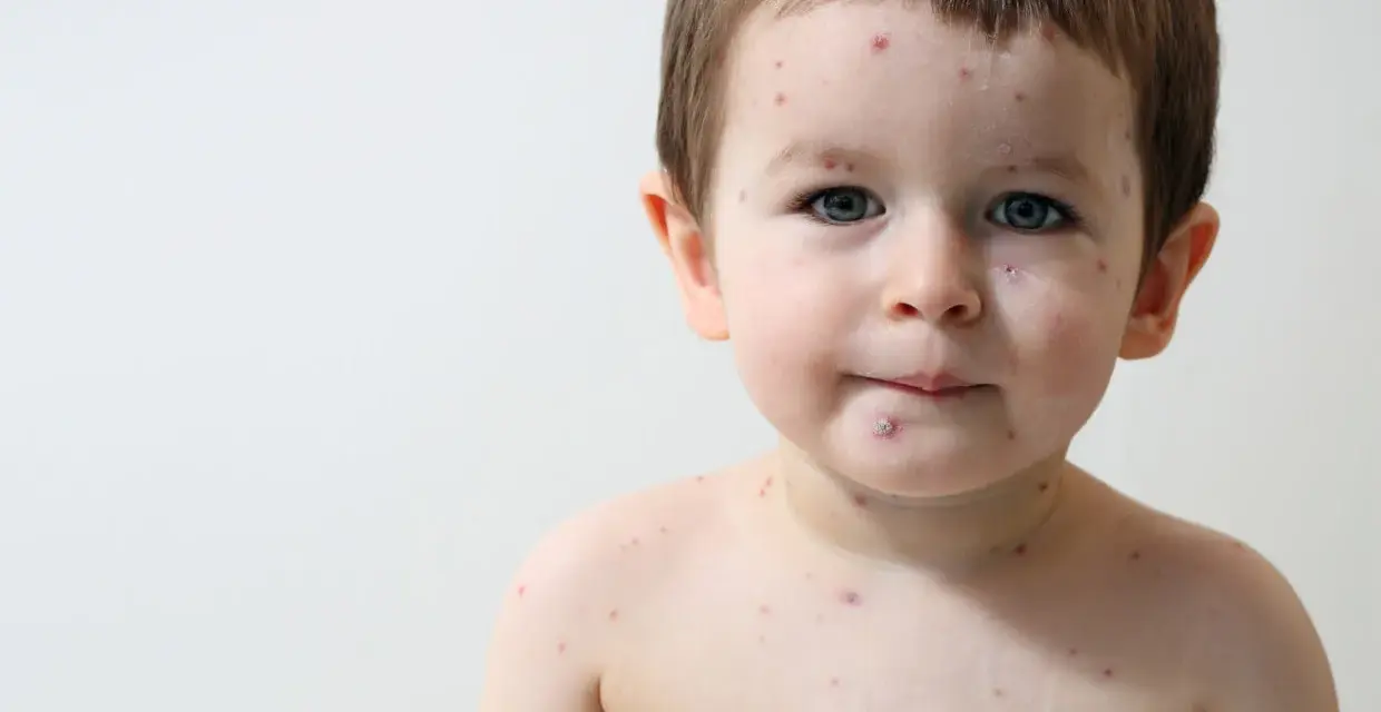 Bambino di 2 anni con puntini rossi intorno alla bocca e sul corpo, forse varicella.