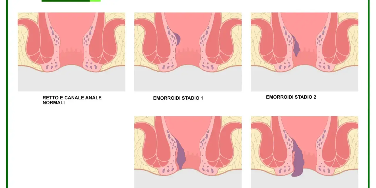 Illustrazione dei gradi di emorroidi, da normali a stadio 4. Capire quando preoccuparsi è fondamentale.