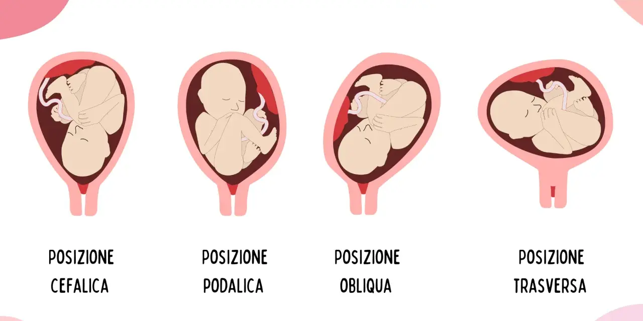 Illustrazione mostra le posizioni del feto: cefalica, podalica, obliqua e trasversa. La posizione podalica è quella in cui il bambino è seduto, con i piedi verso il basso.