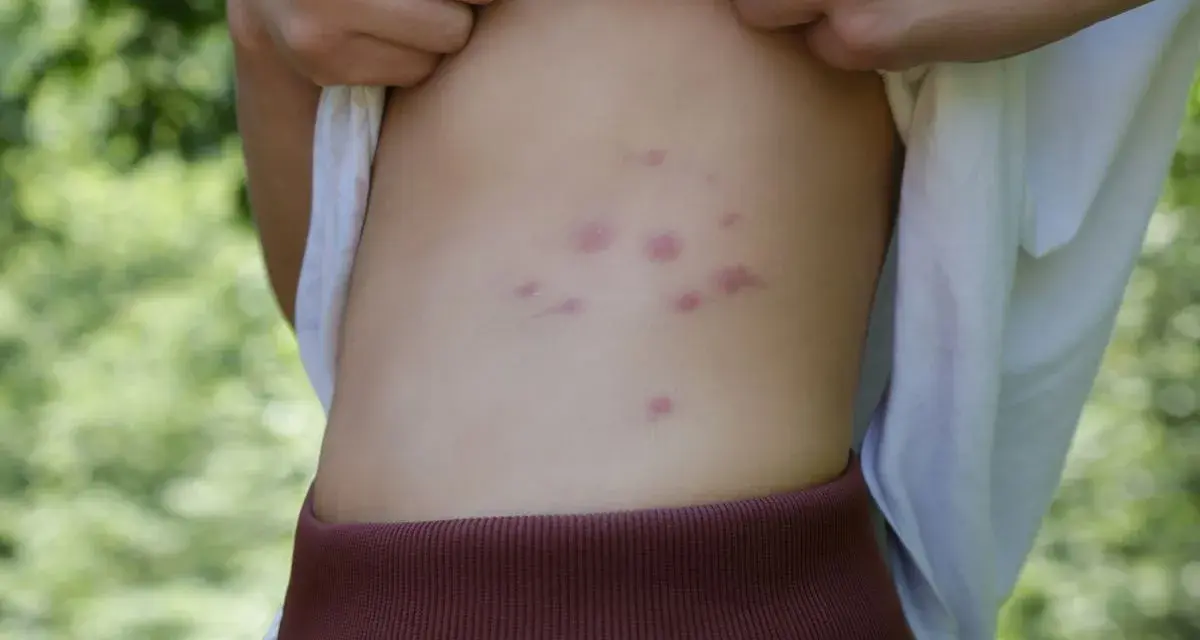 Punture di acari rosse e pruriginose sul fianco di una persona, con sfondo verde sfocato.