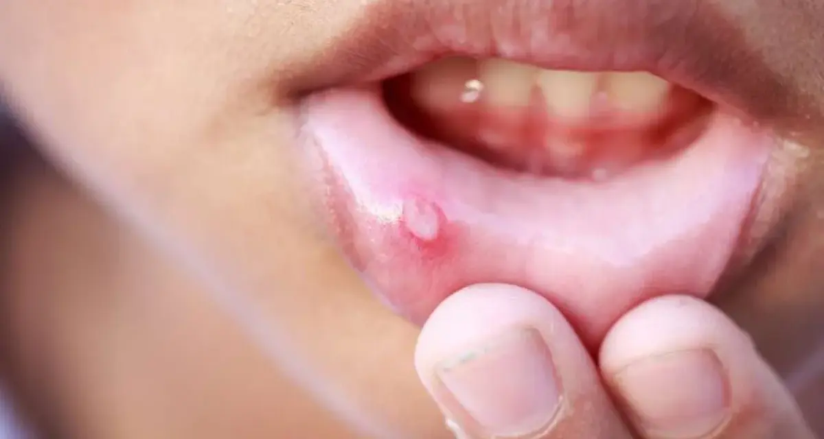 Dito si vede una stomatite aftosa, un'ulcera dolorosa sul labbro interno, che causa disagio.