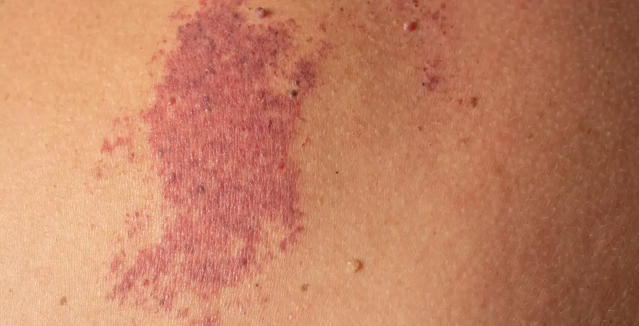 Macchia rossastra sulla pelle, simile a un morso della cicogna adulto, con piccole protuberanze.