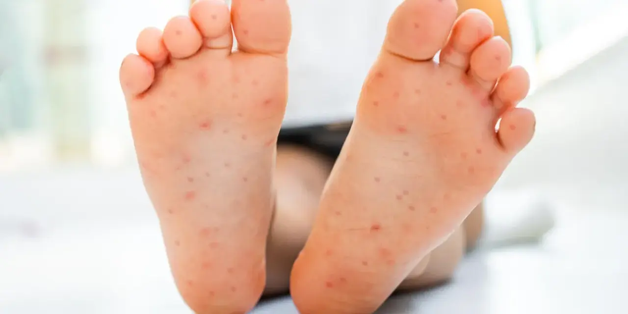 Piedi di bambino con eruzione cutanea, possibile contagio mani bocca. I genitori preoccupati cercano risposte.