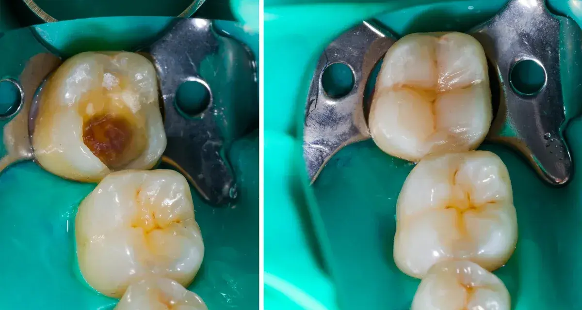 Prima e dopo: un dente con carie profonda e il suo ripristino con otturazione estetica.