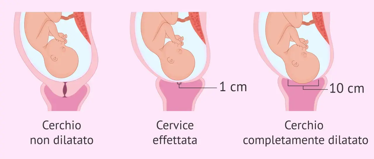 Illustrazione del nono mese di gravidanza: utero con feto, cervice non dilatata, dilatata 1 cm e completamente dilatata (10 cm).