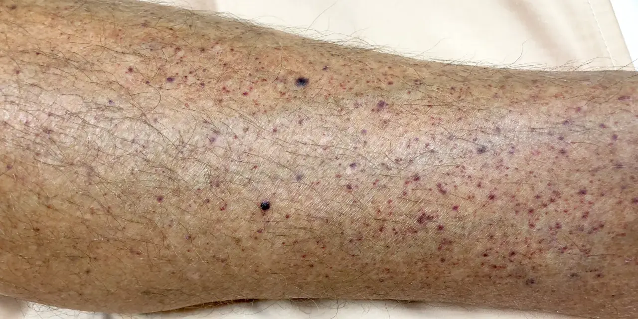 Gambe con numerosi puntini rossi e qualche neo scuro, senza segni di prurito.