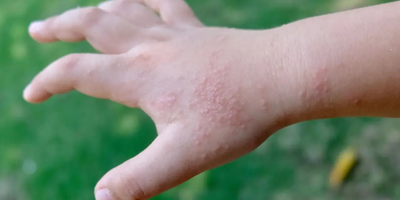 Mano di bambino con puntini rossi sulle dita e sul dorso, senza segni di prurito.