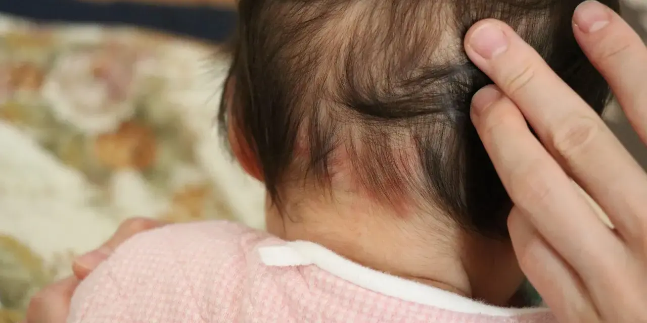 Dita accarezzano la nuca di un neonato, dove si notano delle piccole macchie rosse, un segno del "morso della cicogna".