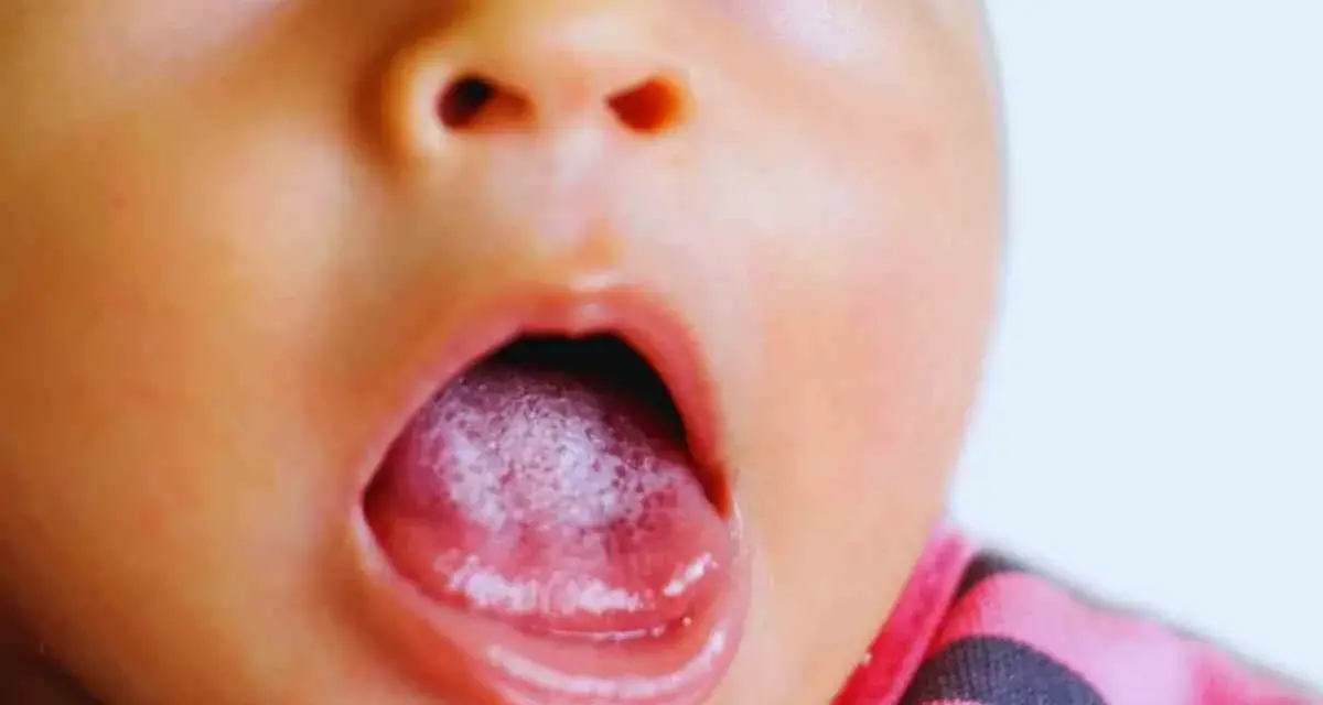 Primo piano del volto di un neonato con la bocca aperta, mostrando il palato bianco e la lingua rosa.