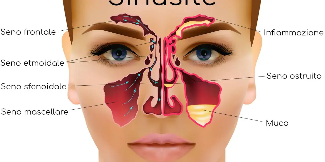 Illustrazione anatomica della sinusite, con seni frontali, etmoidali, sfenoidali e mascellari infiammati e ostruiti da muco. Utile per capire i rimedi.