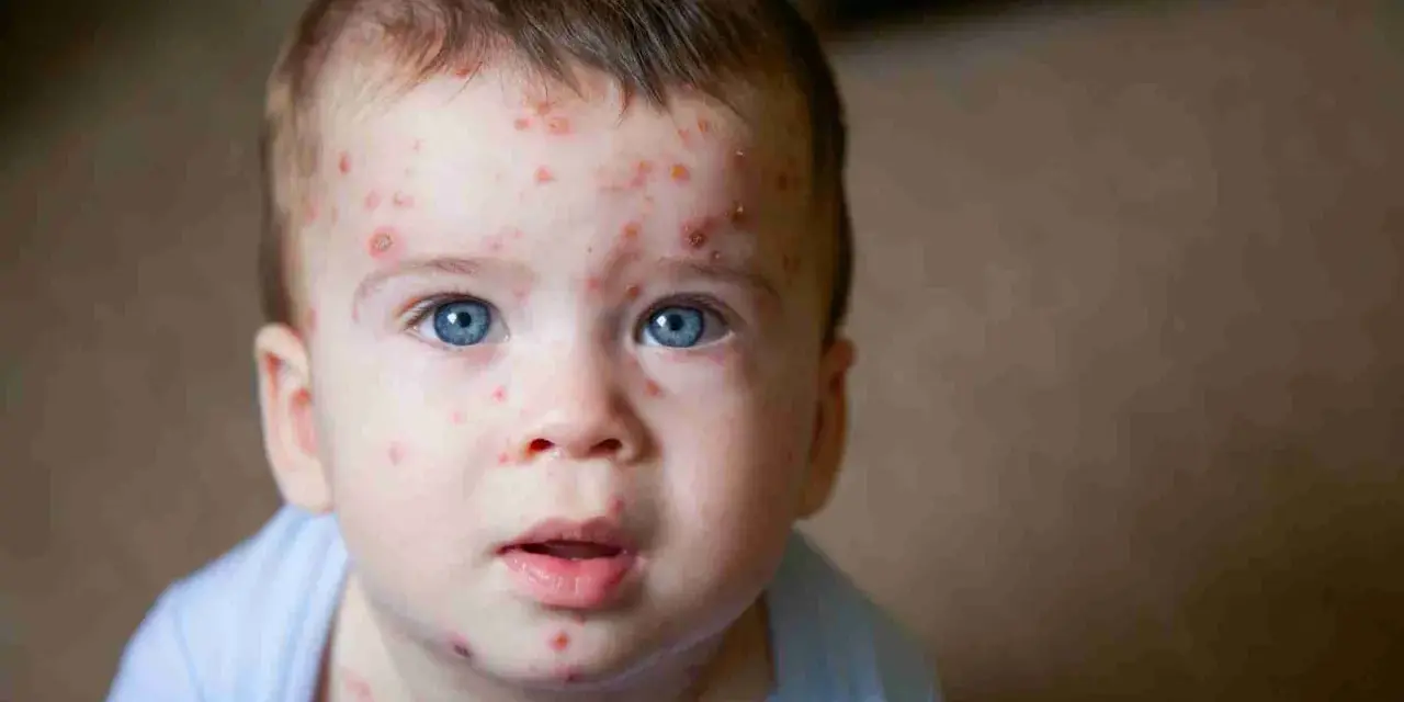 Bambino con eruzioni cutanee tipiche della quinta malattia. La cura è solitamente sintomatica, ma è bene consultare un medico.