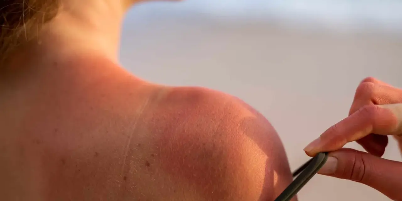 Spalla arrossata dal sole, un tentativo di come abbronzarsi velocemente, ma attenzione alle scottature!