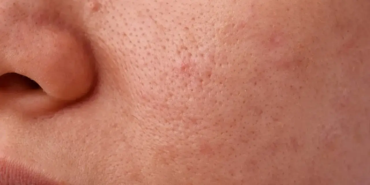 Primo piano della pelle con pori dilatati e alcuni punti neri visibili, che creano una texture irregolare.
