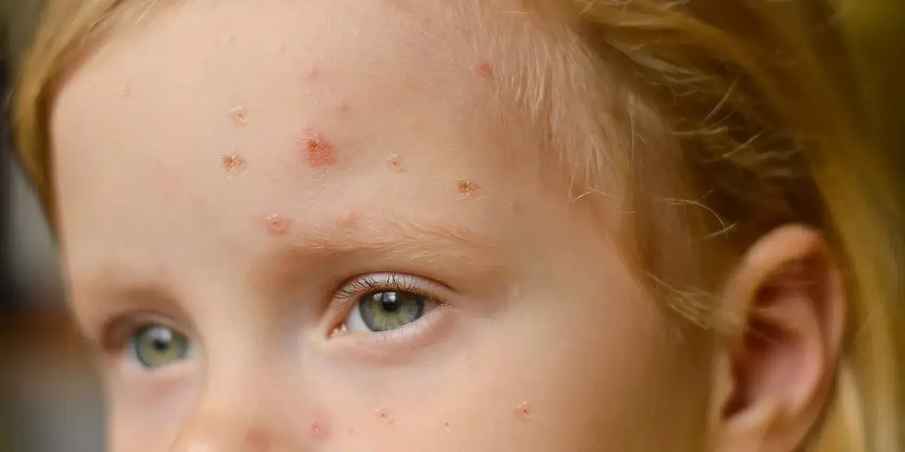 Viso di bambina con eruzioni cutanee, possibili segni di orticaria da streptococco nei bambini.