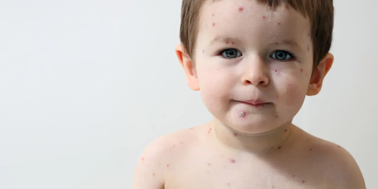 Bambino con puntini rossi sul viso e sul corpo, forse la varicella.