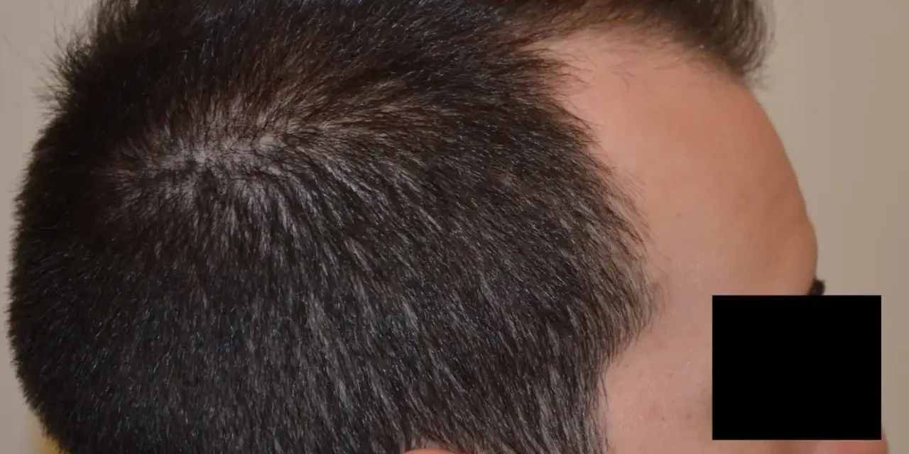 Profilo di un uomo con diradamento dei capelli nella zona della corona, indicativo di alopecia androgenetica.