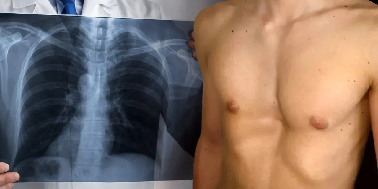 Medico mostra radiografia torace, evidenziando un petto a imbuto.