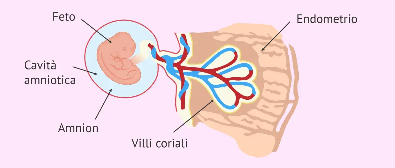 Feto nella cavità amniotica, collegato ai villi coriali nell'endometrio. Il sacco vitellino senza embrione è visibile.