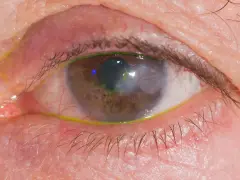 Occhio con segni di herpes, arrossamento e secrezioni giallastre. La cornea presenta un'area opaca e verdeggiante.
