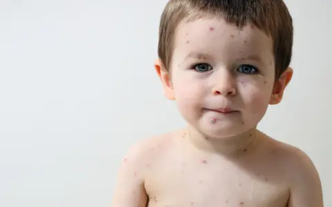 Bambino di 2 anni con puntini rossi intorno alla bocca e sul corpo, forse varicella.