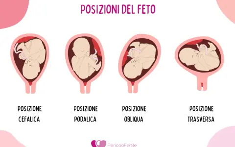 Illustrazione mostra le posizioni del feto: cefalica, podalica, obliqua e trasversa. La posizione podalica è quella in cui il bambino è seduto, con i piedi verso il basso.