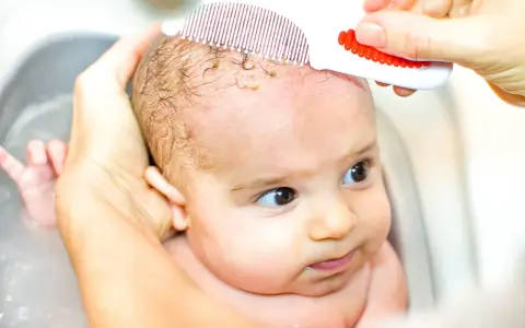 Mani delicate rimuovono la crosta lattea dal cuoio capelluto di un neonato con un pettinino bianco e rosso.