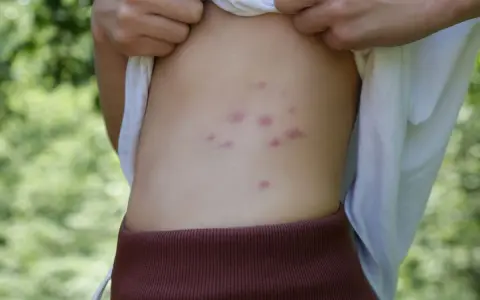 Punture di acari rosse e pruriginose sul fianco di una persona, con sfondo verde sfocato.