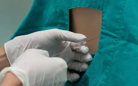 Mani guantate eseguono un'iniezione epidurale, sollevando interrogativi sugli epidurale effetti collaterali a lungo termine.